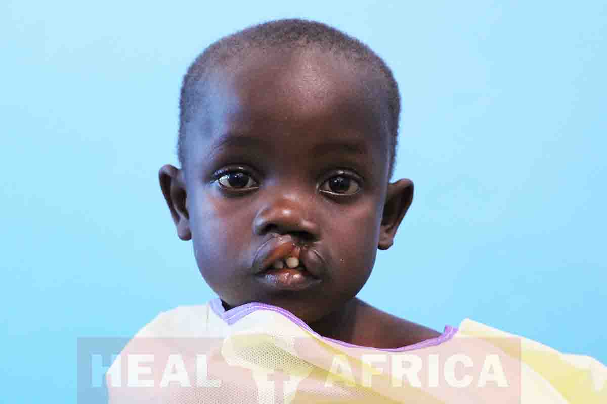 Â« Les fentes labiales et palatines ne font pas obstacle Ã  la vie : elles sont rÃ©parables Â»