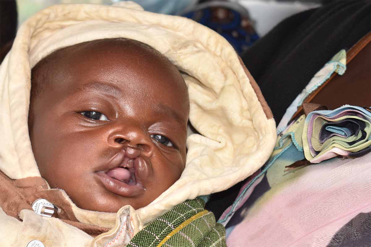 Â« Les fentes labiales et palatines ne font pas obstacle Ã  la vie : elles sont rÃ©parables Â»