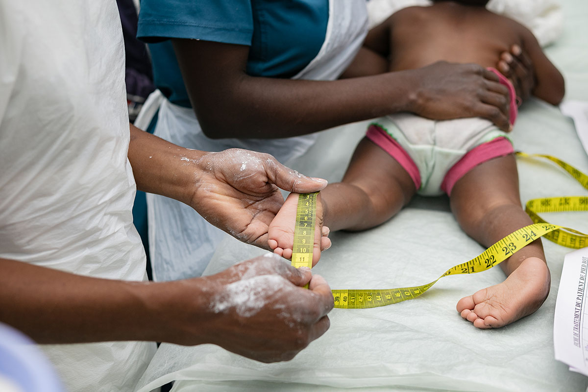 Prise en charge des pieds bots à HEAL Africa : Des soins gratuits pour corriger la malformation dès le plus jeune âge